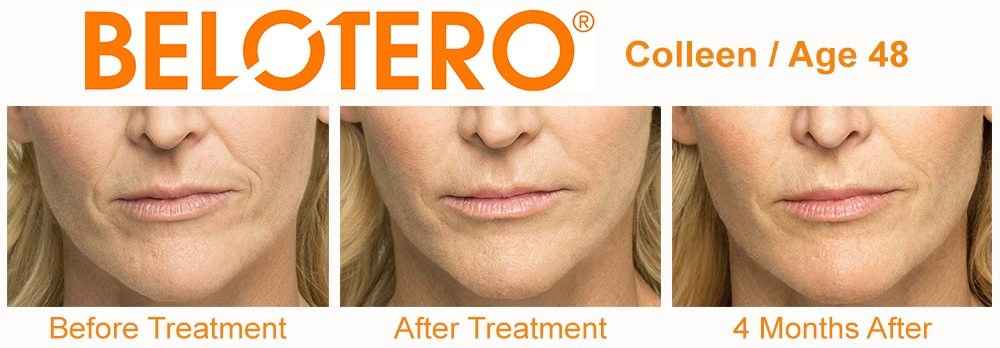 https://captivate207.com/wp-content/uploads/2018/12/Belotero-Before-and-After-in-Houston-Skin-101.jpg