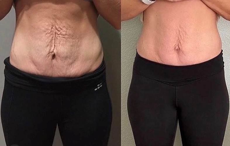 V-FORM B&A (4) V-FORM B&A (4)