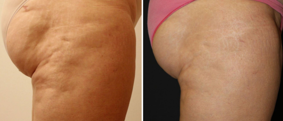 V-FORM Cellulite V-FORM Cellulite